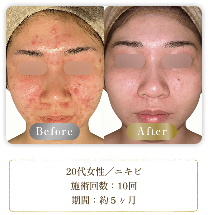 20代女性／ニキビ 施術回数：10回 期間：約５ヶ月