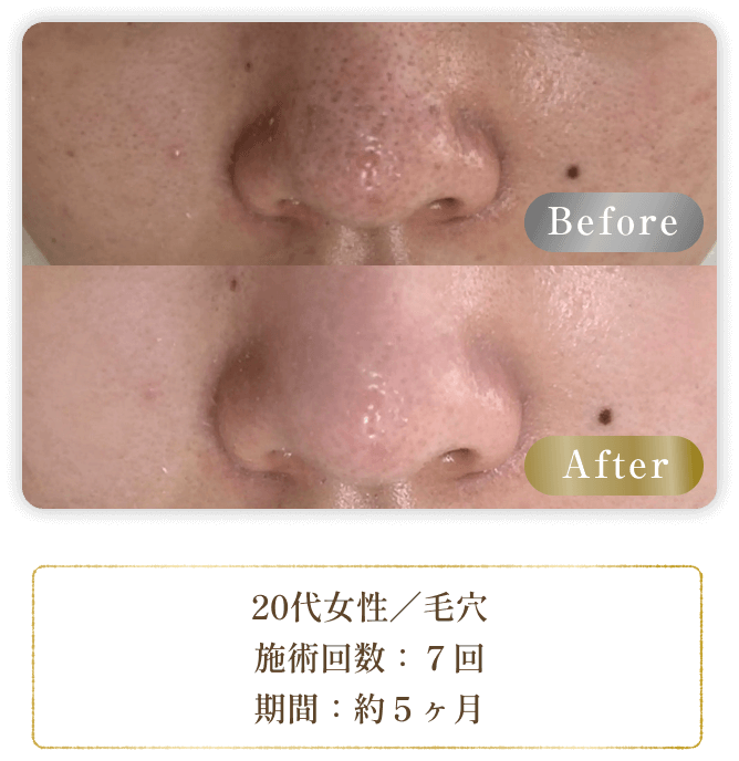 20代女性／毛穴 施術回数：７回 期間：約５ヶ月