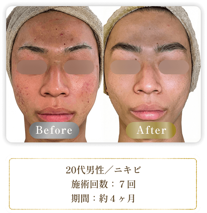 20代男性／ニキビ 施術回数：７回 期間：約４ヶ月