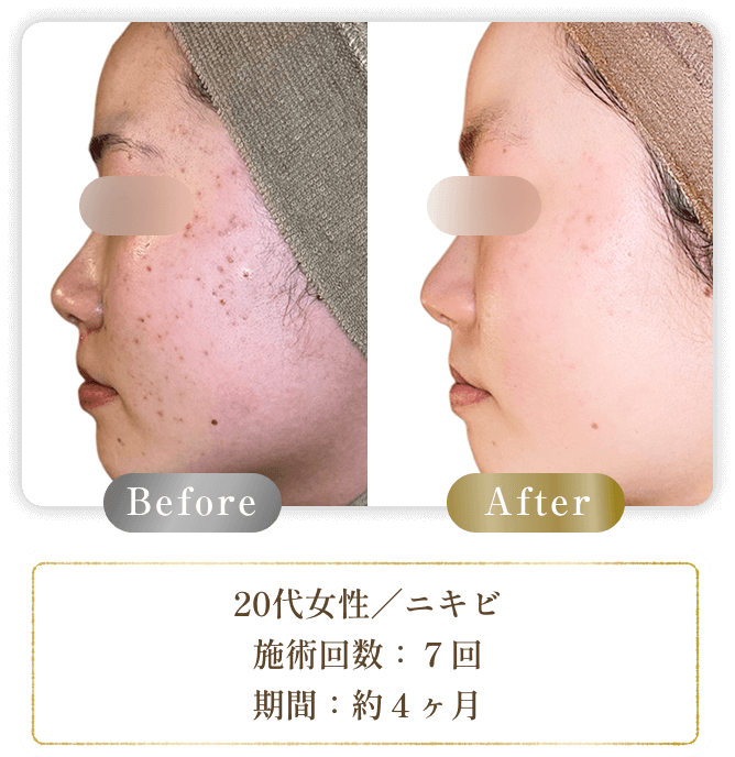20代女性／ニキビ 施術回数：７回 期間：約４ヶ月